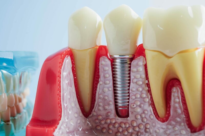 dental implants phoenix